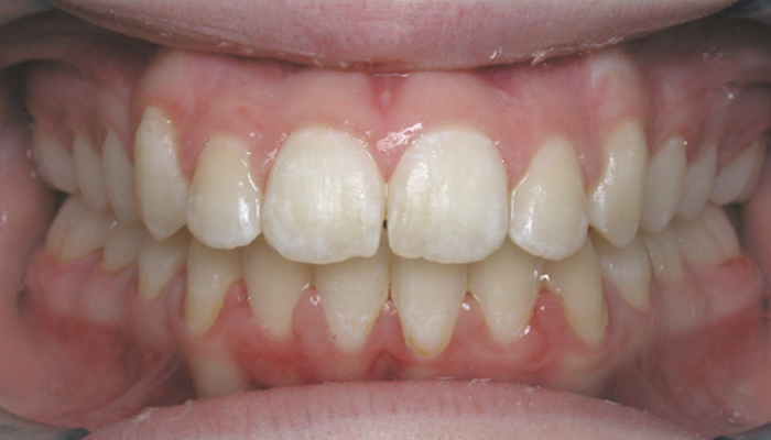 Bethany Orthodontics - Braces