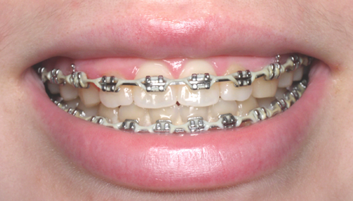 Clear Braces, Portland Orthodontist